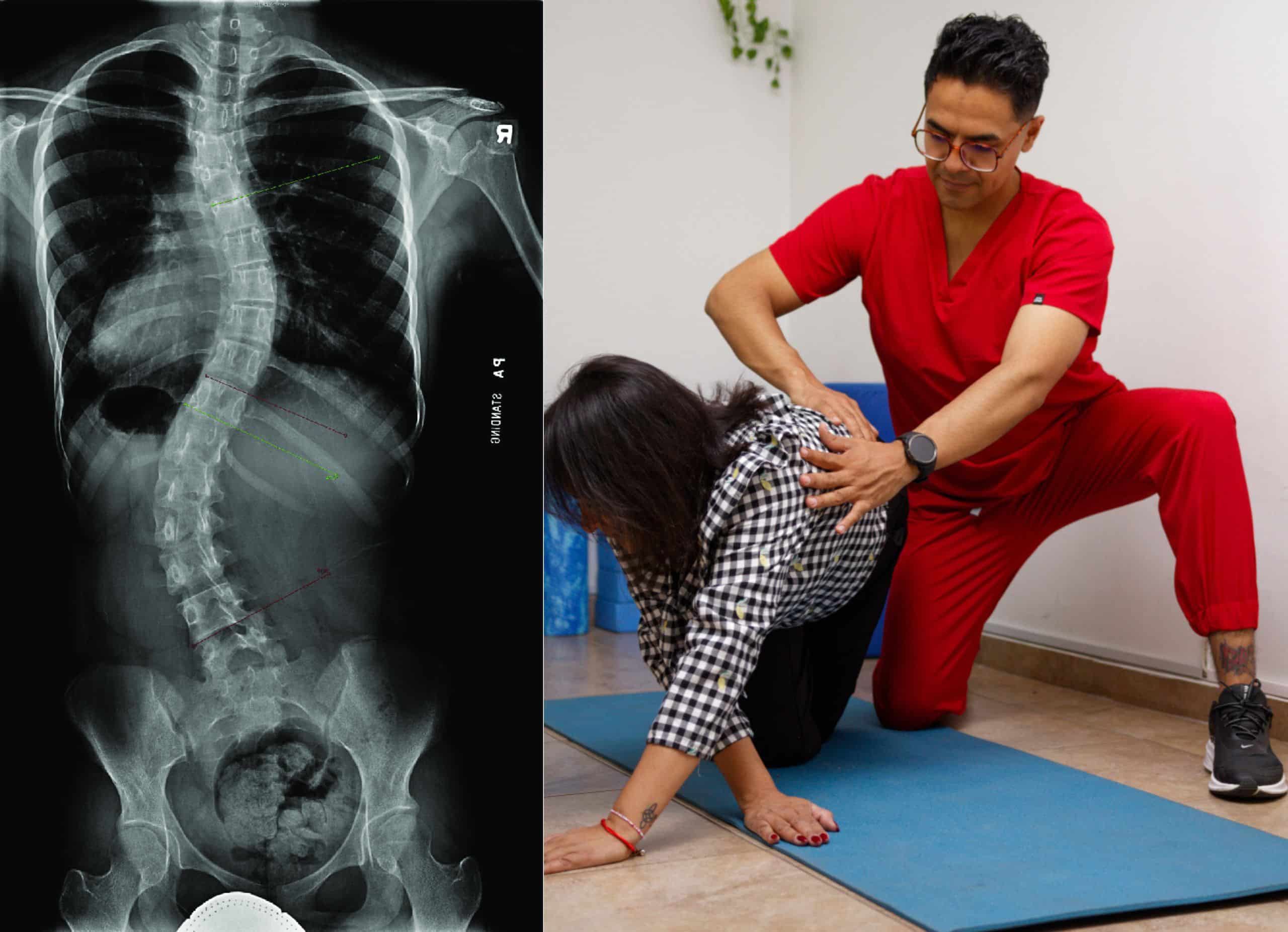 radiografía full spine y ejercicios de rehabilitación